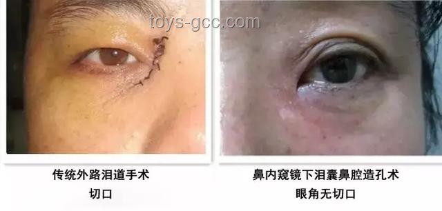 **泪囊异常症状对比：女子右眼狂飙泪与常见泪道疾病**